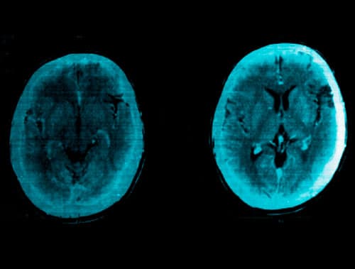 TAC de cráneo con contraste con encefalomalacia focal perisilviana izquierda leve, sin presencia de calcificaciones cerebrales.